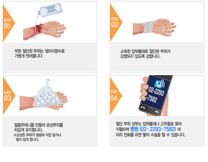 부분 절단 시 응급처치 4단계 안내 그림 — 생리식염수 세척, 압박붕대 감싸기, 얼음주머니로 차갑게, 병원 사전 연락