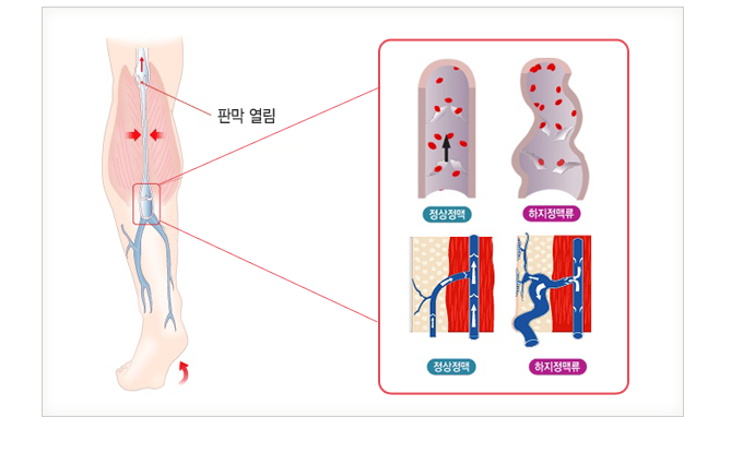 정상 정맥과 하지정맥류 비교 — 판막 열림
