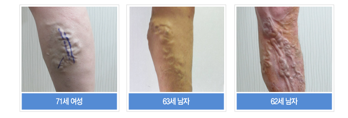 하지정맥류 사례 — 71세 여성, 63세 남성, 62세 남성