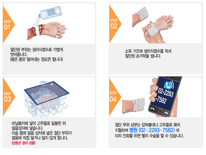 완전 절단 시 응급처치 4단계 안내 그림 — 생리식염수 세척, 젖은 거즈로 감싸기, 비닐봉지 밀봉 후 얼음상자, 병원 사전 연락