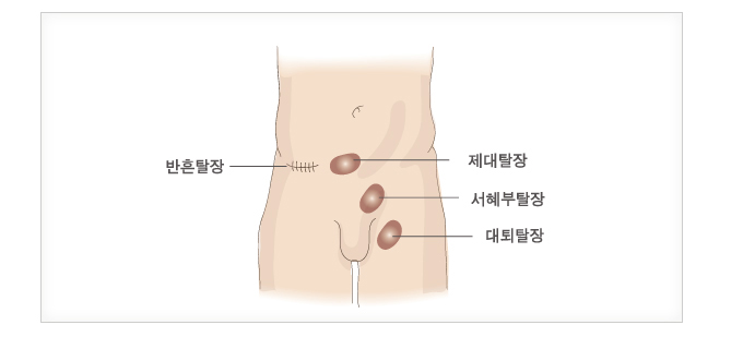 탈장 발생 부위 — 반흔탈장·제대탈장·서혜부탈장·대퇴탈장